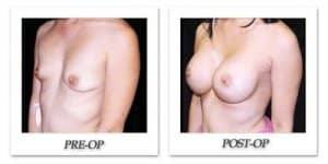 phoca_thumb_l_mandris-breast-augmentation-094