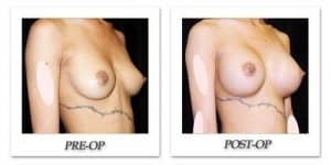 phoca_thumb_l_mandris-breast-augmentation-096
