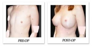 phoca_thumb_l_mandris-breast-augmentation-098