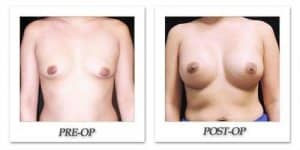 phoca_thumb_l_mandris-breast-augmentation-099