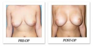 phoca_thumb_l_mandris-breast-augmentation-101
