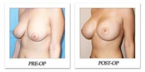 phoca_thumb_l_mandris-breast-augmentation-102