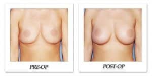 phoca_thumb_l_phoca_thumb_l_anous-breast-augmentation-052b