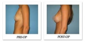 phoca_thumb_l_phoca_thumb_l_bruno-breast-augmentation-038b