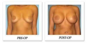 phoca_thumb_l_phoca_thumb_l_bruno-breast-augmentation-041b