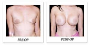 phoca_thumb_l_phoca_thumb_l_mandris-breast-augmentation-093b