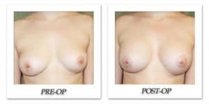 phoca_thumb_l_before-after-009