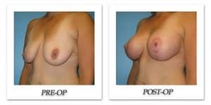 phoca_thumb_l_bruno-breast-lift-002
