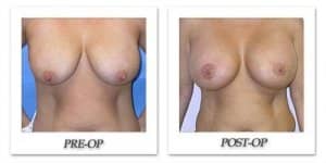 phoca_thumb_l_mandris-breast-lift-005