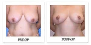 phoca_thumb_l_mandris-breast-lift-007