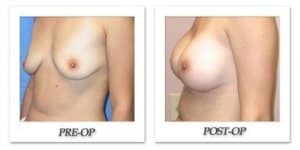 phoca_thumb_l_mandris-breast-lift-012