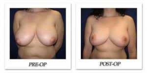 phoca_thumb_l_cohen-breast-reduction-001