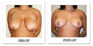 phoca_thumb_l_cohen-breast-reduction-005