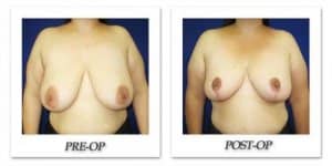 phoca_thumb_l_cohen-breast-reduction-010