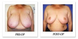 phoca_thumb_l_cohen-breast-reduction-014