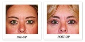 phoca_thumb_l_dr-begovic-eyelid-surgery-before-after-001