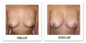 Breast Augmentation by Dr. Kincaid