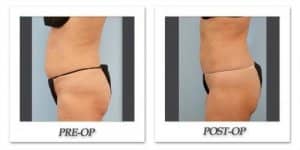 phoca_thumb_l_dr-begovic-liposuction-before-after-002