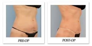phoca_thumb_l_dr-begovic-liposuction-before-after-005