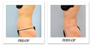 phoca_thumb_l_dr-begovic-liposuction-before-after-006