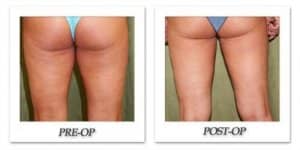 phoca_thumb_l_dr-begovic-liposuction-before-after-011