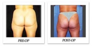 phoca_thumb_l_hodnett-liposuction-011