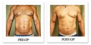 phoca_thumb_l_liposuction-before-after-015