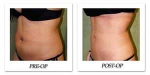 phoca_thumb_l_liposuction-before-after-019