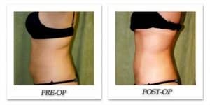 phoca_thumb_l_liposuction-before-after-020