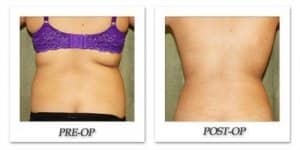 phoca_thumb_l_liposuction-before-after-024