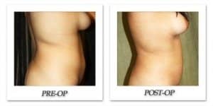 phoca_thumb_l_liposuction-before-after-026