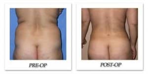 phoca_thumb_l_mandris-liposuction-016