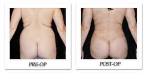 phoca_thumb_l_mandris-liposuction-026