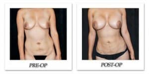 phoca_thumb_l_mandris-liposuction-033