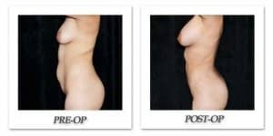 phoca_thumb_l_mandris-liposuction-034