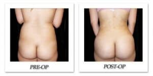 phoca_thumb_l_mandris-liposuction-038