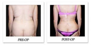phoca_thumb_l_mandris-liposuction-040