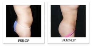 phoca_thumb_l_mandris-liposuction-045