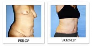 phoca_thumb_l_dr-begovic-tummy-tuck-before-after-001