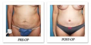 phoca_thumb_l_dr-begovic-tummy-tuck-before-after-006