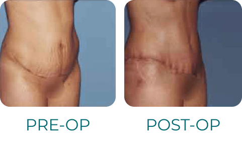 Tummy Tuck Revision - Beverly Hills Physicians