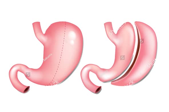 Stock Vector Laparoscopic Gastrectomy Gastric Sleeve Also Known As The Greater Curve Gastrectomy Vertical 1135976798 1
