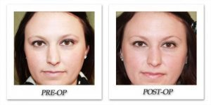 phoca_thumb_m_dr-begovic-rhinoplasty-before-after-004-front