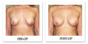 phoca_thumb_l_before-after-002