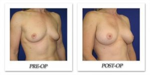 phoca_thumb_l_cohen-breast-augmentation-003
