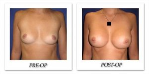 phoca_thumb_l_cohen-breast-augmentation-006