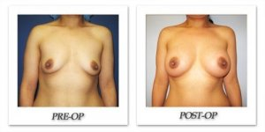phoca_thumb_l_cohen-breast-augmentation-007