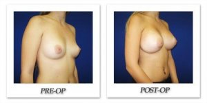 phoca_thumb_l_cohen-breast-augmentation-011