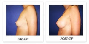 phoca_thumb_l_cohen-breast-augmentation-014