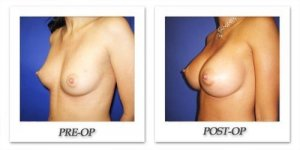 phoca_thumb_l_cohen-breast-augmentation-017